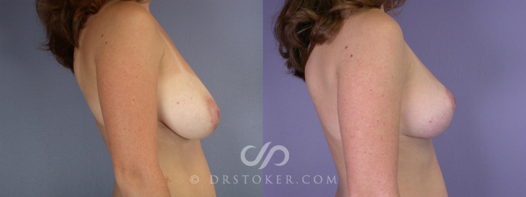Before & After Breast Reduction (for Women) Case 217 View #4 View in Los Angeles, CA