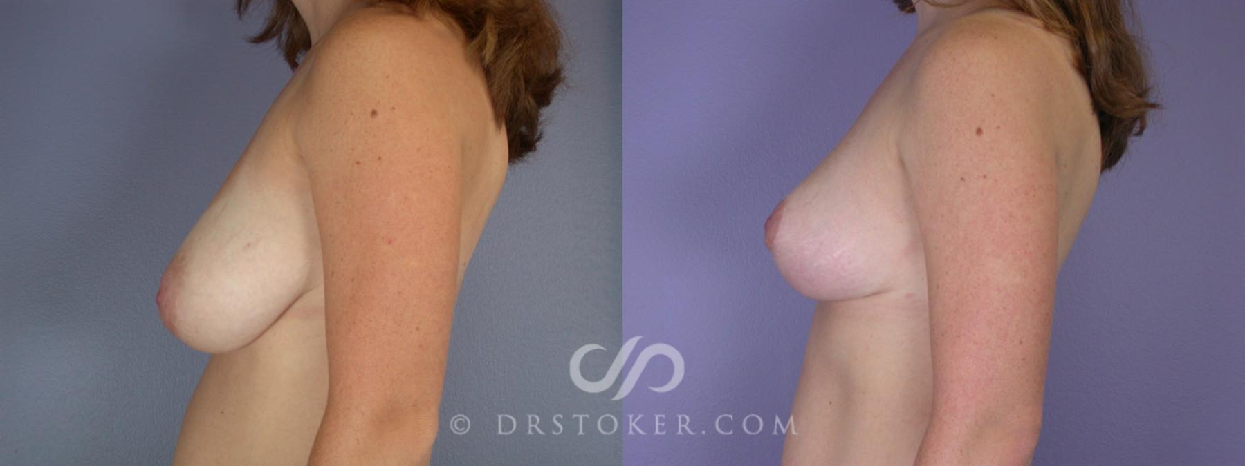 Before & After Breast Reduction (for Women) Case 217 View #5 View in Los Angeles, CA