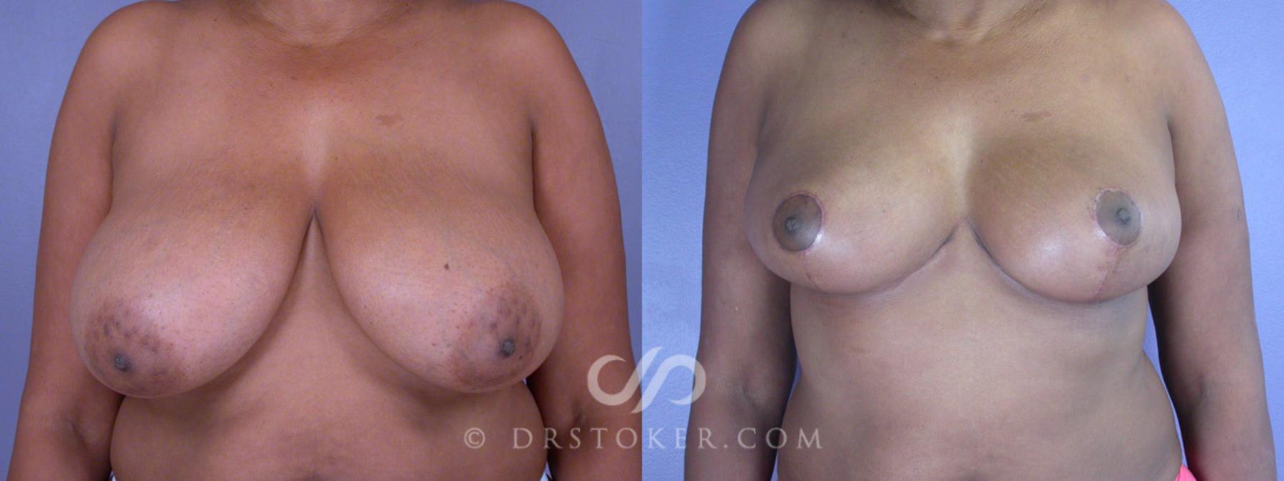 Before & After Breast Reduction (for Women) Case 218 View #1 View in Los Angeles, CA