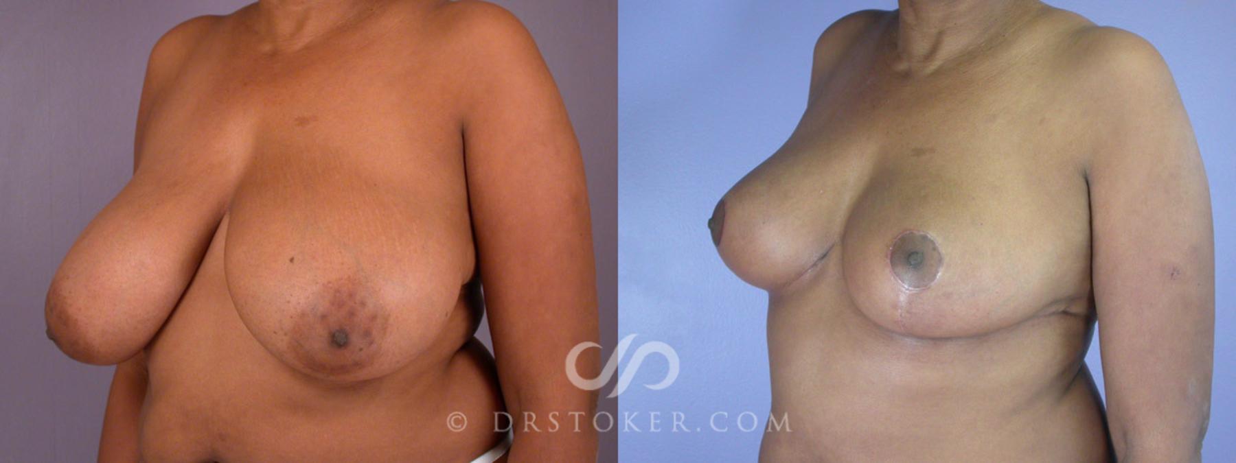 Before & After Breast Reduction (for Women) Case 218 View #2 View in Los Angeles, CA