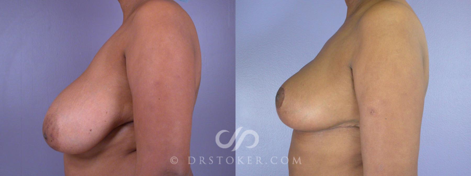 Before & After Breast Reduction (for Women) Case 218 View #3 View in Los Angeles, CA