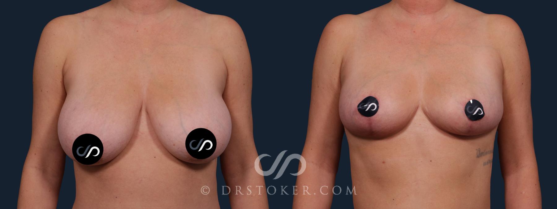 Before & After Breast Reduction (for Women) Case 2183 Front View in Los Angeles, CA