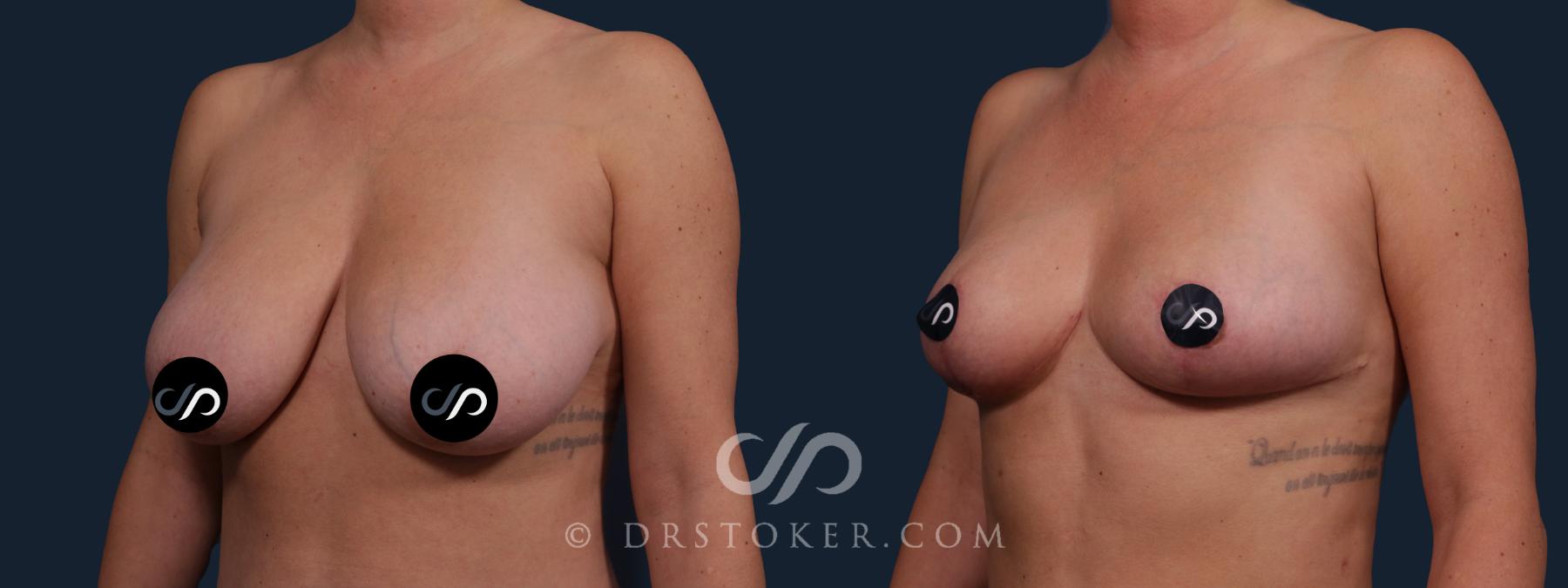 Before & After Breast Lift Case 2183 Left Oblique View in Los Angeles, CA