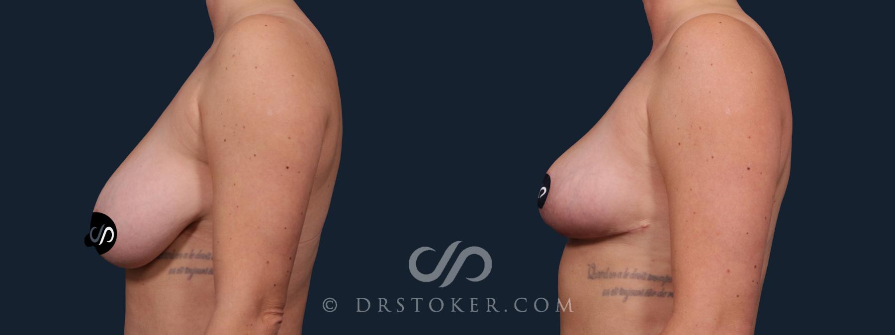 Before & After Breast Lift Case 2183 Left Side View in Los Angeles, CA