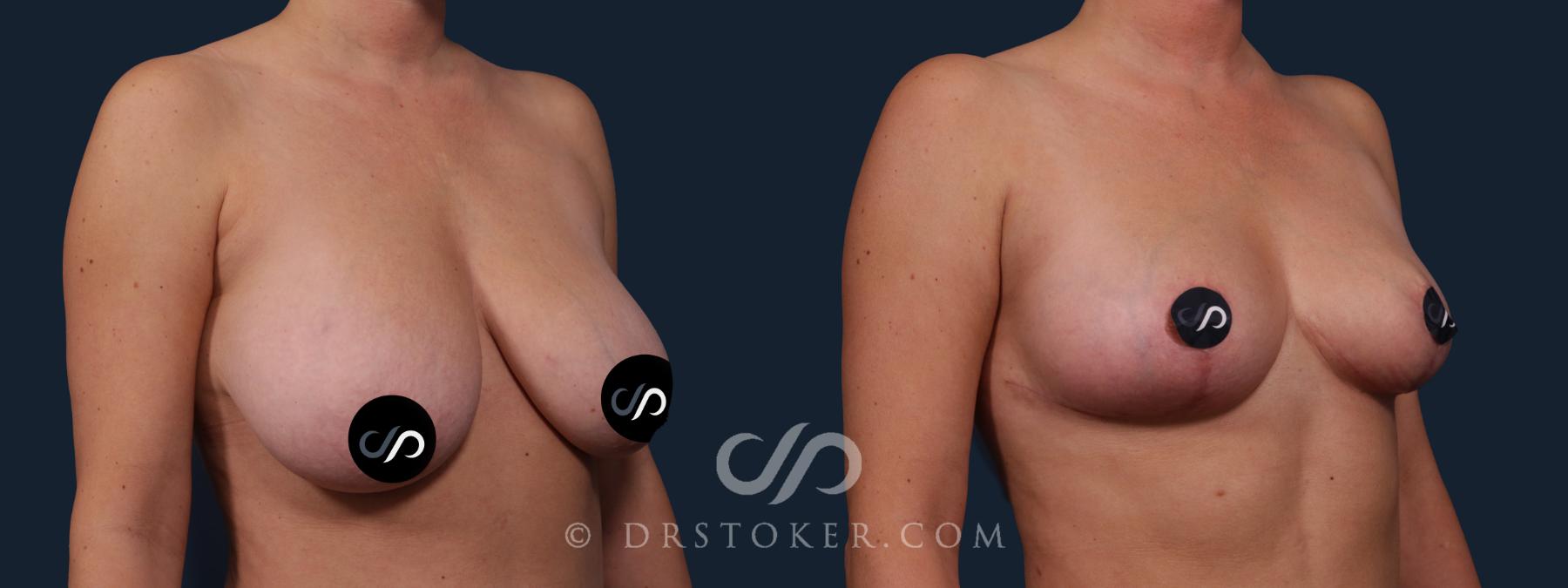 Before & After Breast Lift Case 2183 Right Oblique View in Los Angeles, CA
