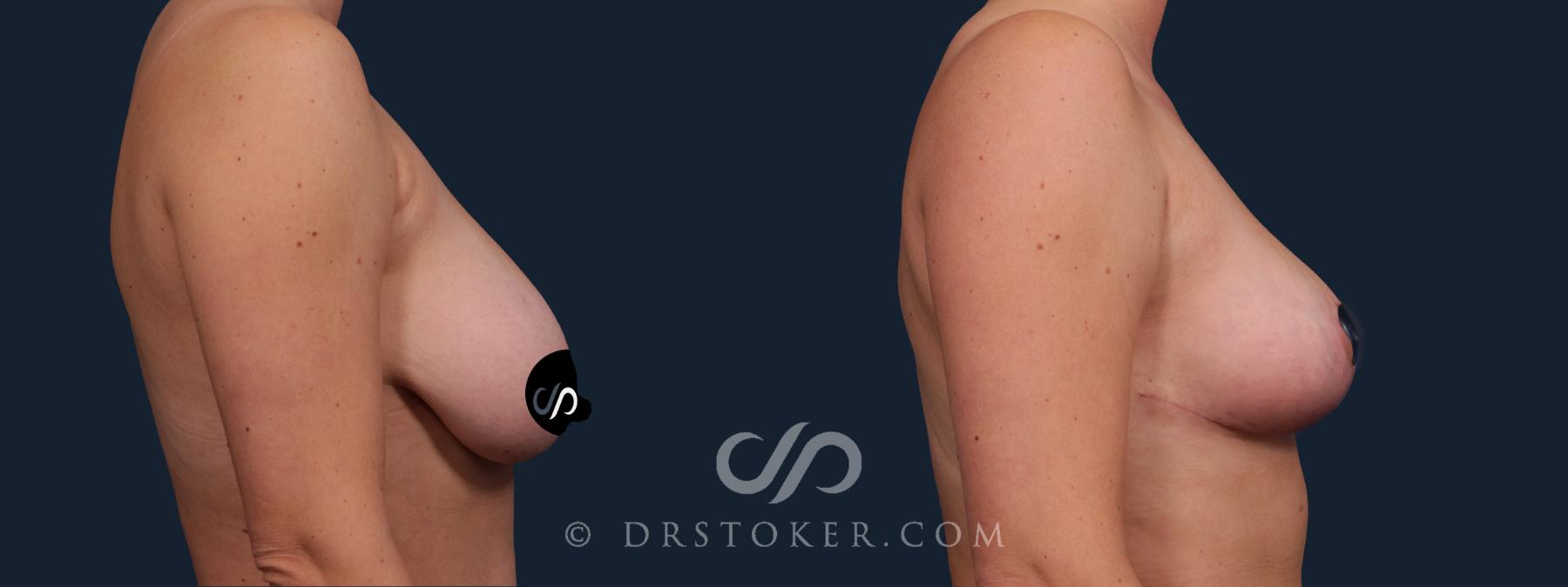 Before & After Breast Lift Case 2183 Right Side View in Los Angeles, CA