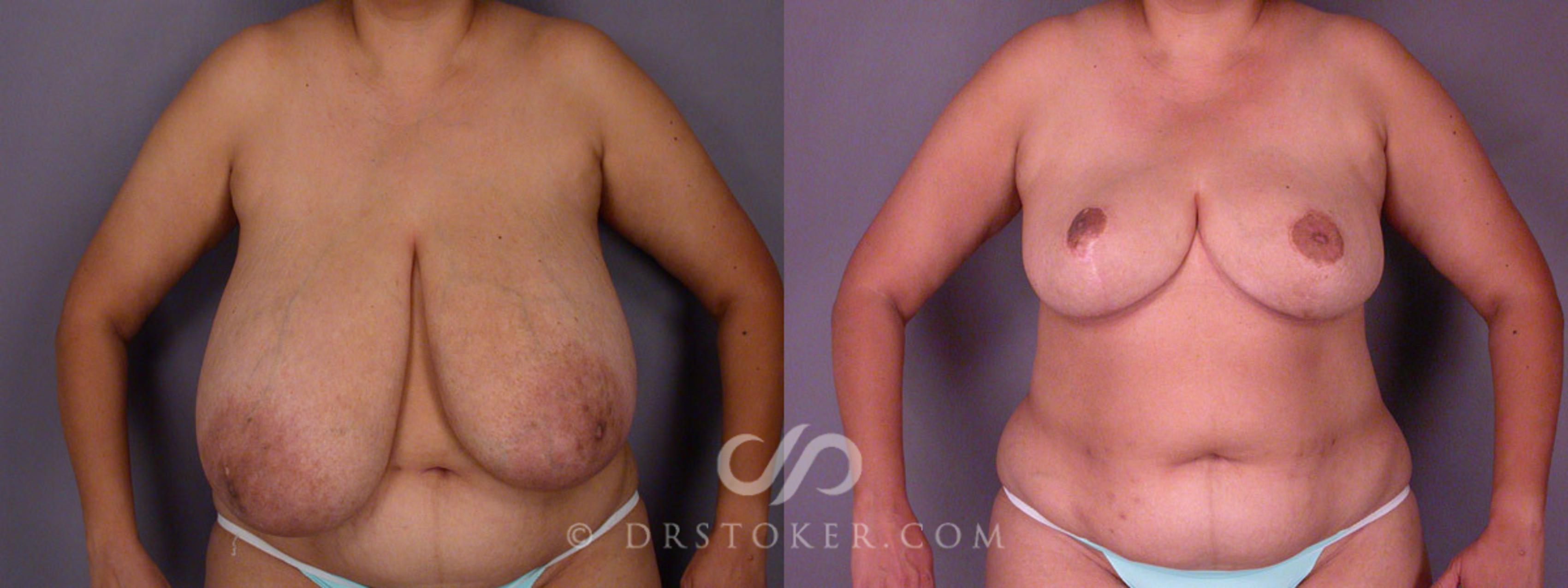 Before & After Breast Reduction (for Women) Case 219 View #1 View in Los Angeles, CA