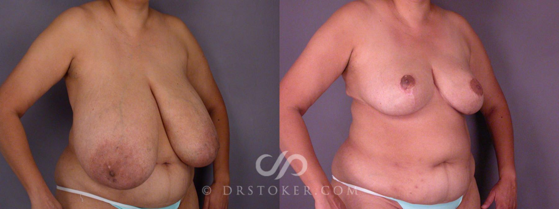 Before & After Breast Reduction (for Women) Case 219 View #2 View in Los Angeles, CA