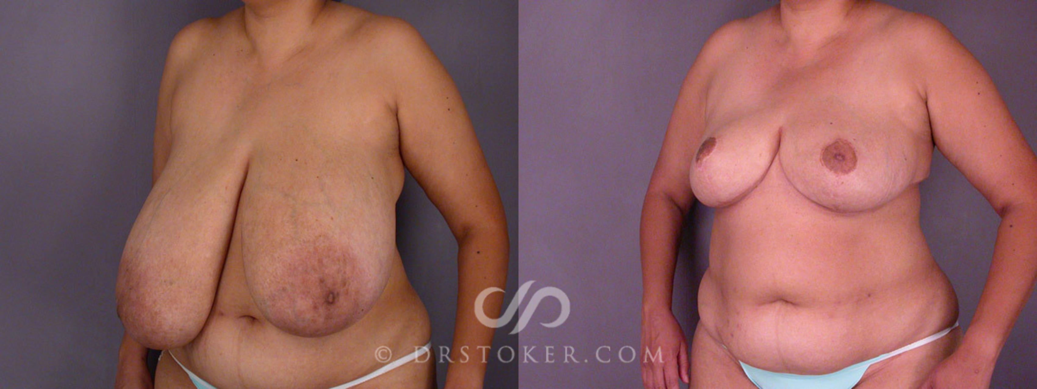 Before & After Breast Reduction (for Women) Case 219 View #3 View in Los Angeles, CA