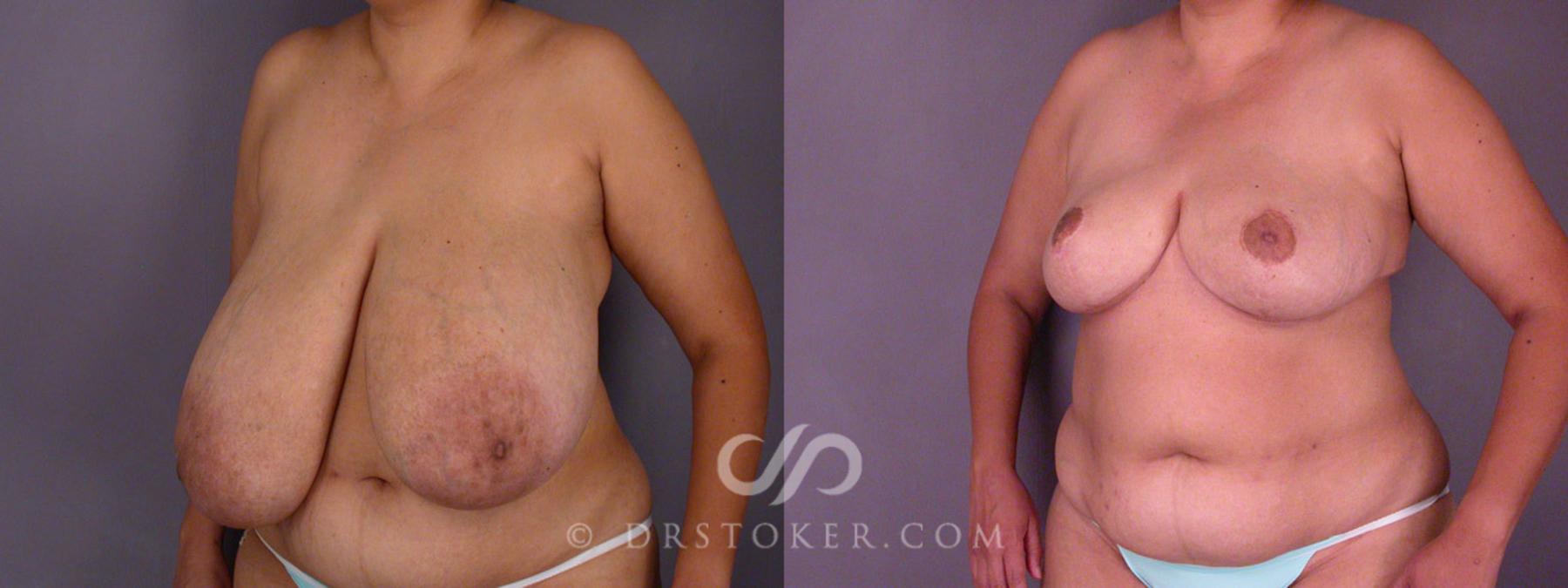 Before & After Breast Asymmetry Correction Case 219 View #3 View in Los Angeles, CA