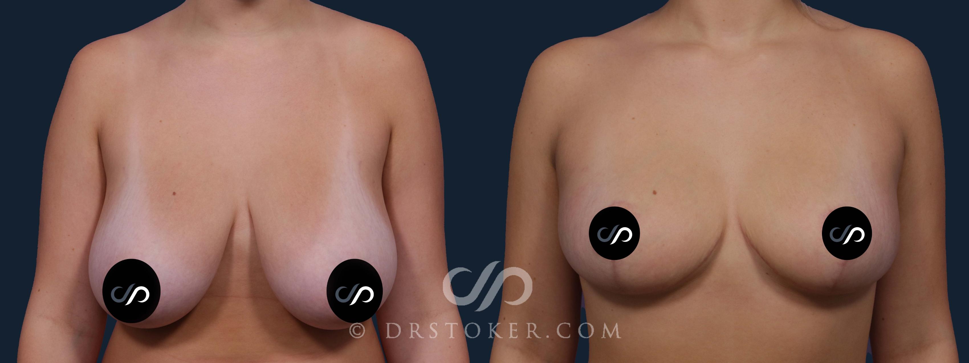 Before & After Breast Lift Case 2191 Front View in Los Angeles, CA
