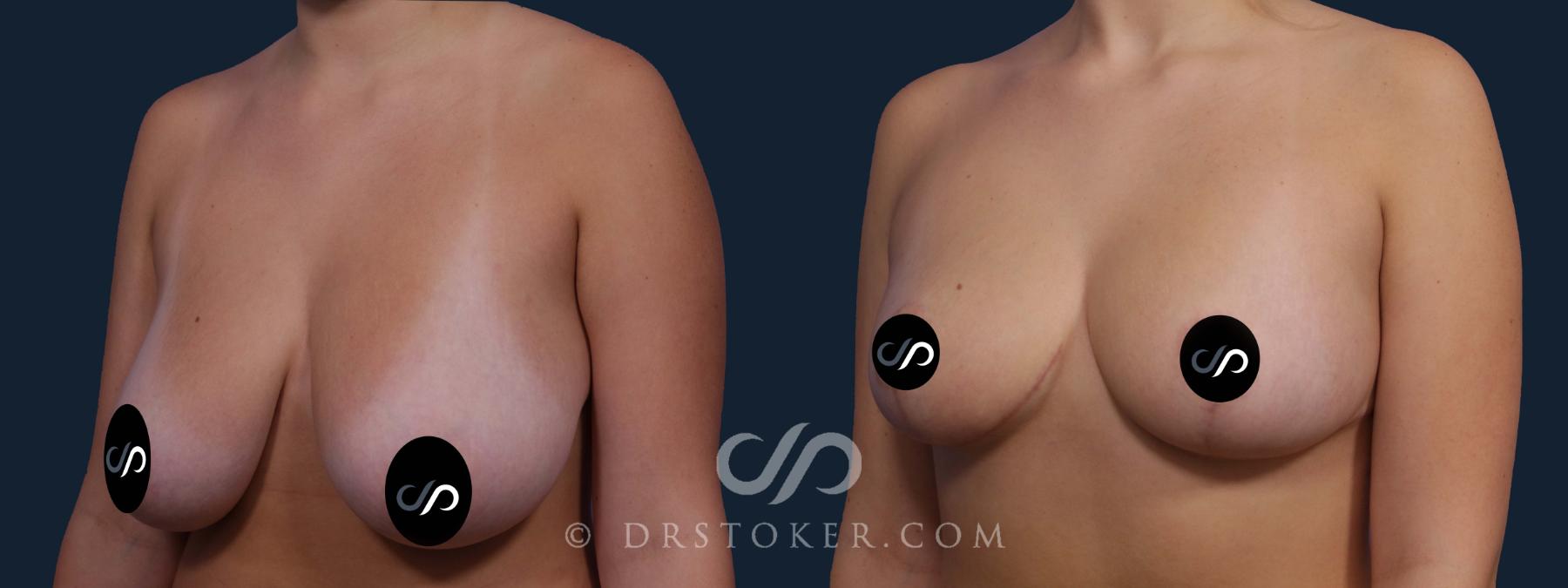 Before & After Breast Reduction (for Women) Case 2191 Left Oblique View in Los Angeles, CA