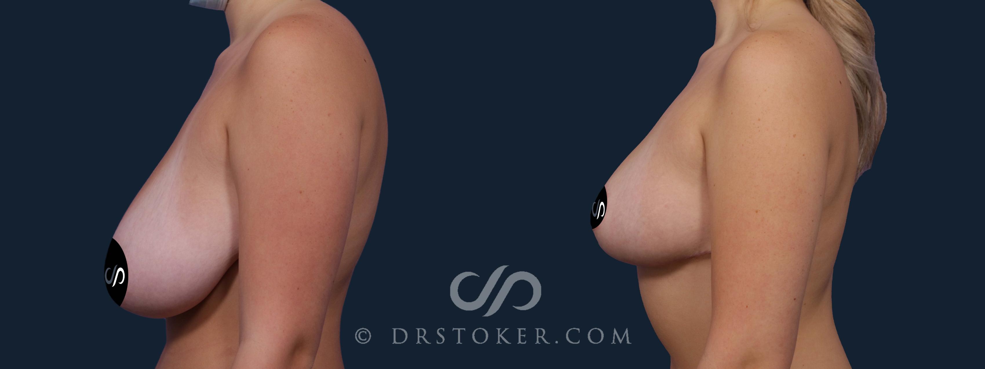 Before & After Breast Reduction (for Women) Case 2191 Left Side View in Los Angeles, CA