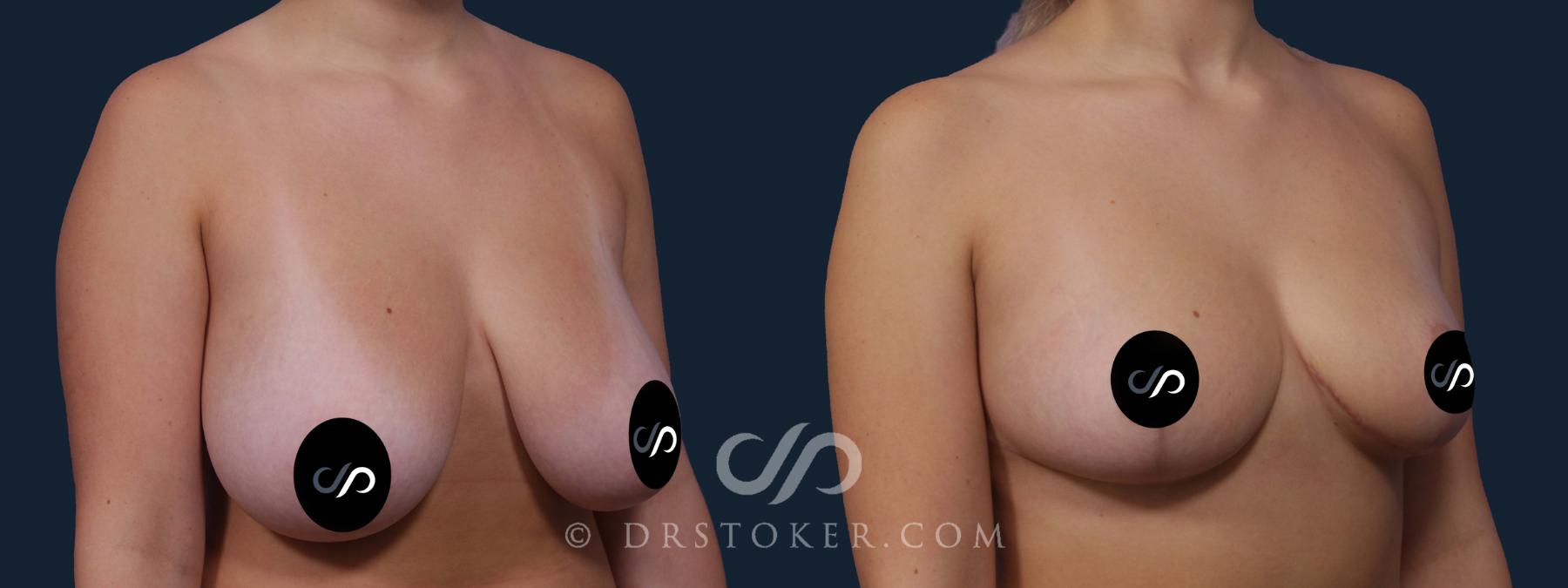 Before & After Breast Reduction (for Women) Case 2191 Right Oblique View in Los Angeles, CA
