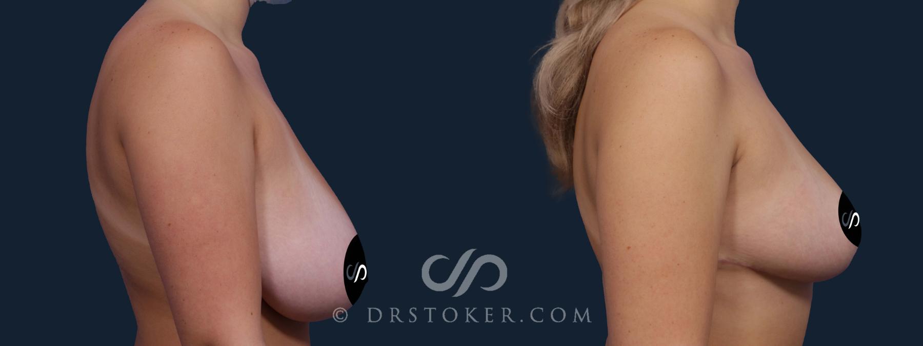 Before & After Breast Reduction (for Women) Case 2191 Right Side View in Los Angeles, CA
