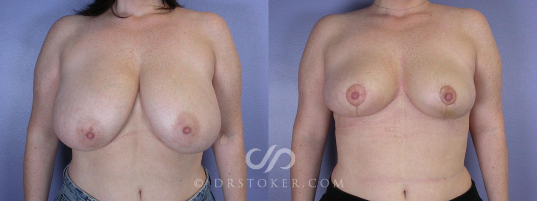 Before & After Breast Reduction (for Women) Case 220 View #1 View in Los Angeles, CA