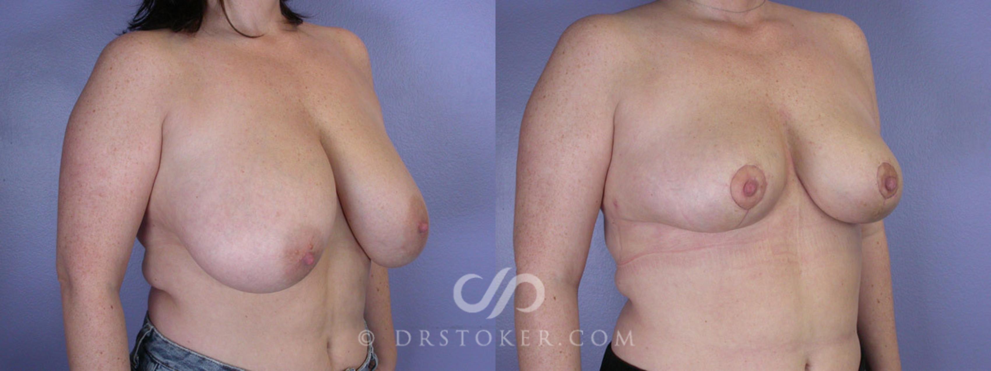 Before & After Breast Reduction (for Women) Case 220 View #2 View in Los Angeles, CA