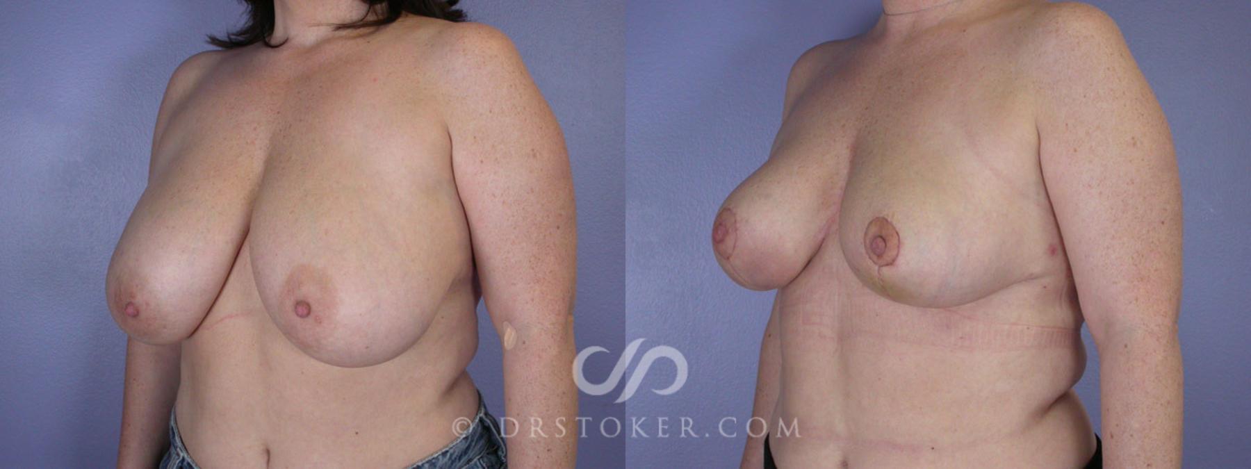 Before & After Breast Reduction (for Women) Case 220 View #3 View in Los Angeles, CA