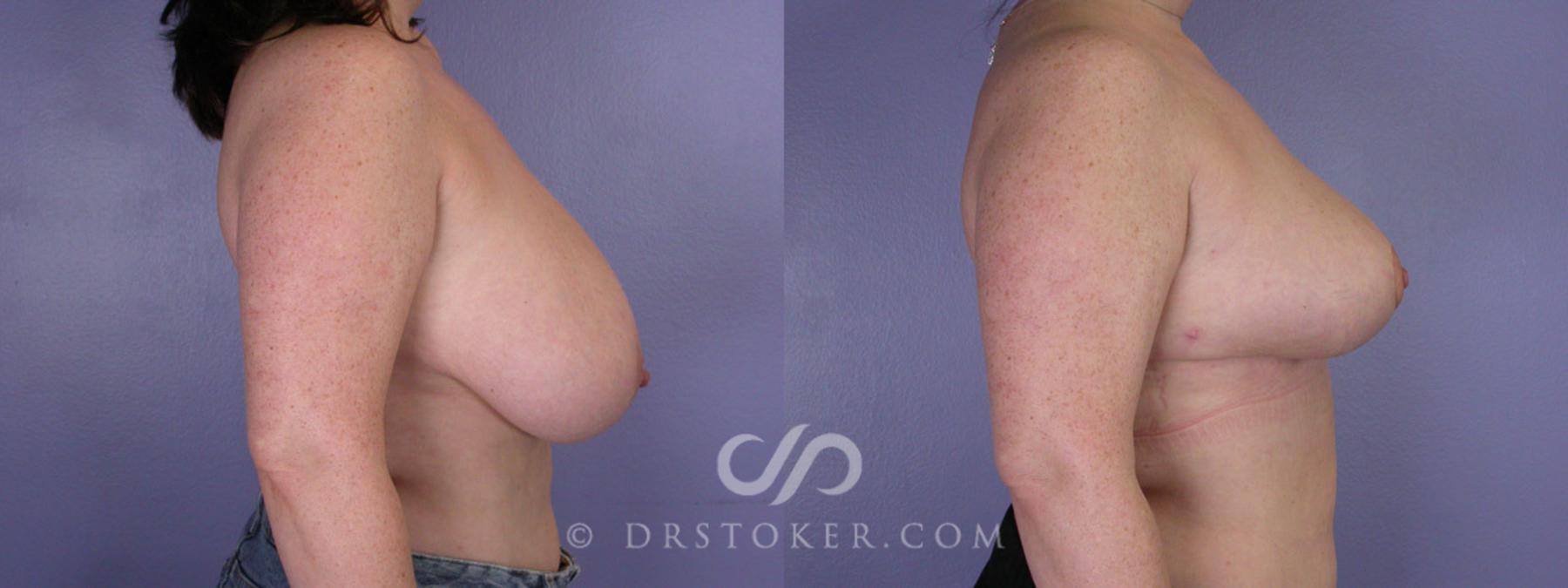 Before & After Breast Reduction (for Women) Case 220 View #4 View in Los Angeles, CA