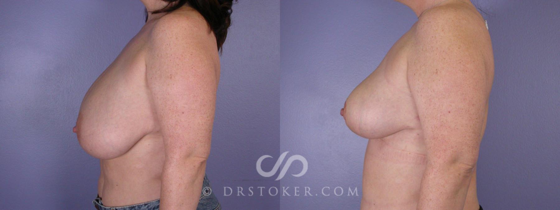 Before & After Breast Reduction (for Women) Case 220 View #5 View in Los Angeles, CA