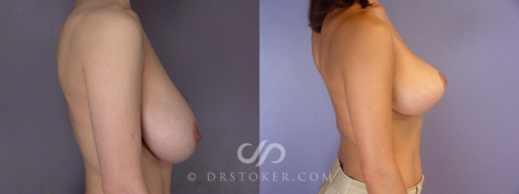 Before & After Breast Reduction (for Women) Case 221 View #4 View in Los Angeles, CA