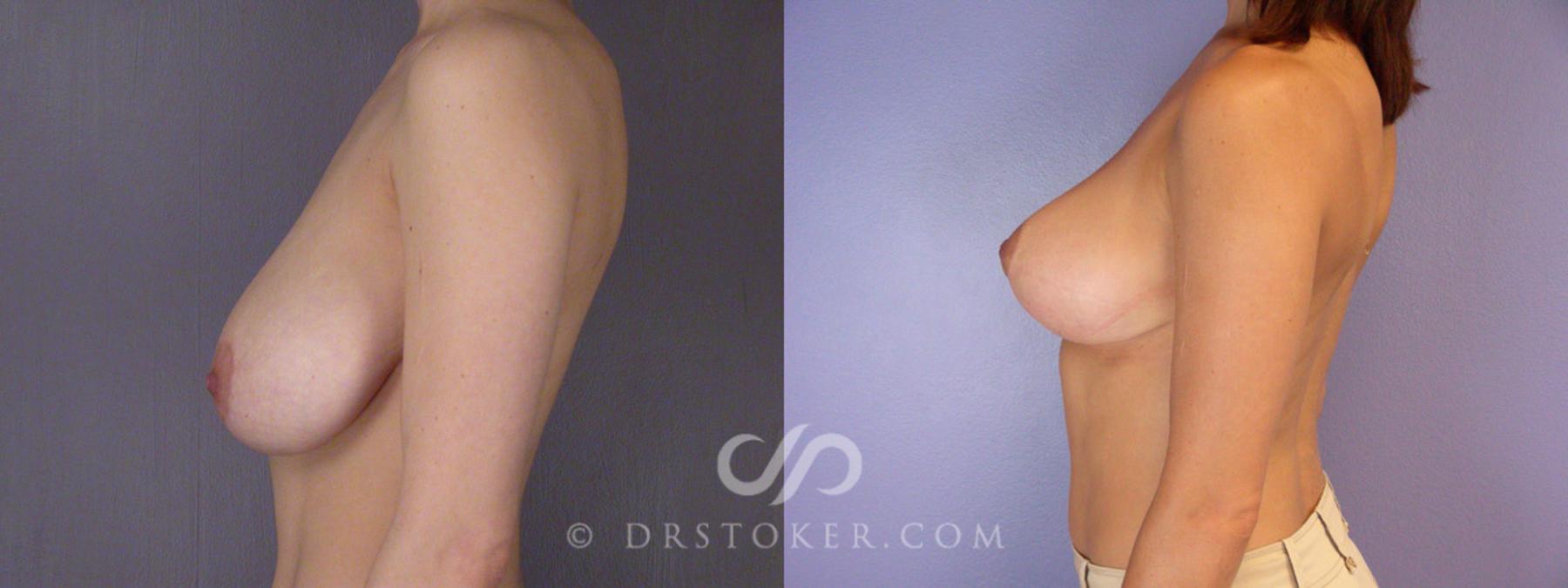 Before & After Breast Reduction (for Women) Case 221 View #5 View in Los Angeles, CA