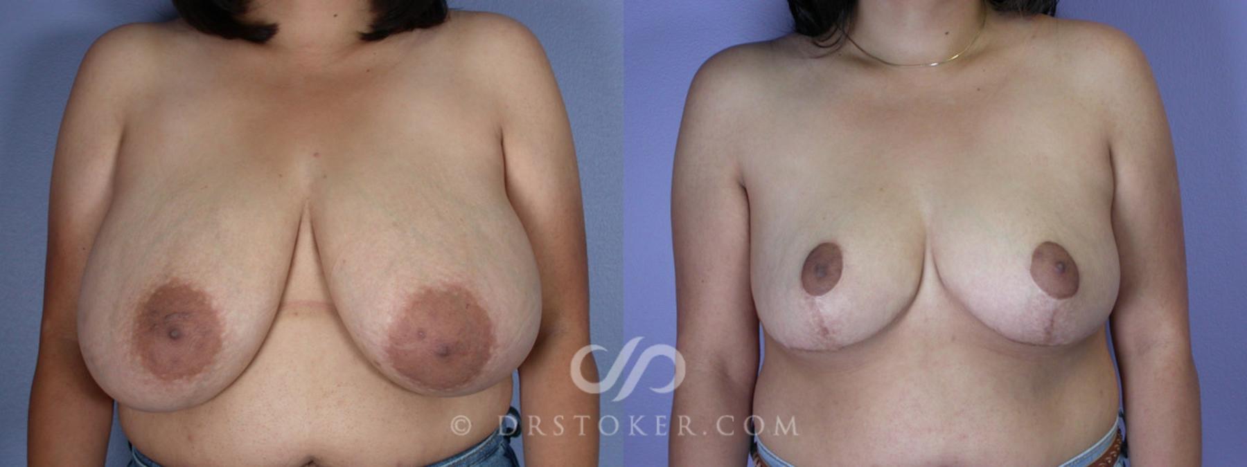 Before & After Breast Reduction (for Women) Case 222 View #1 View in Los Angeles, CA