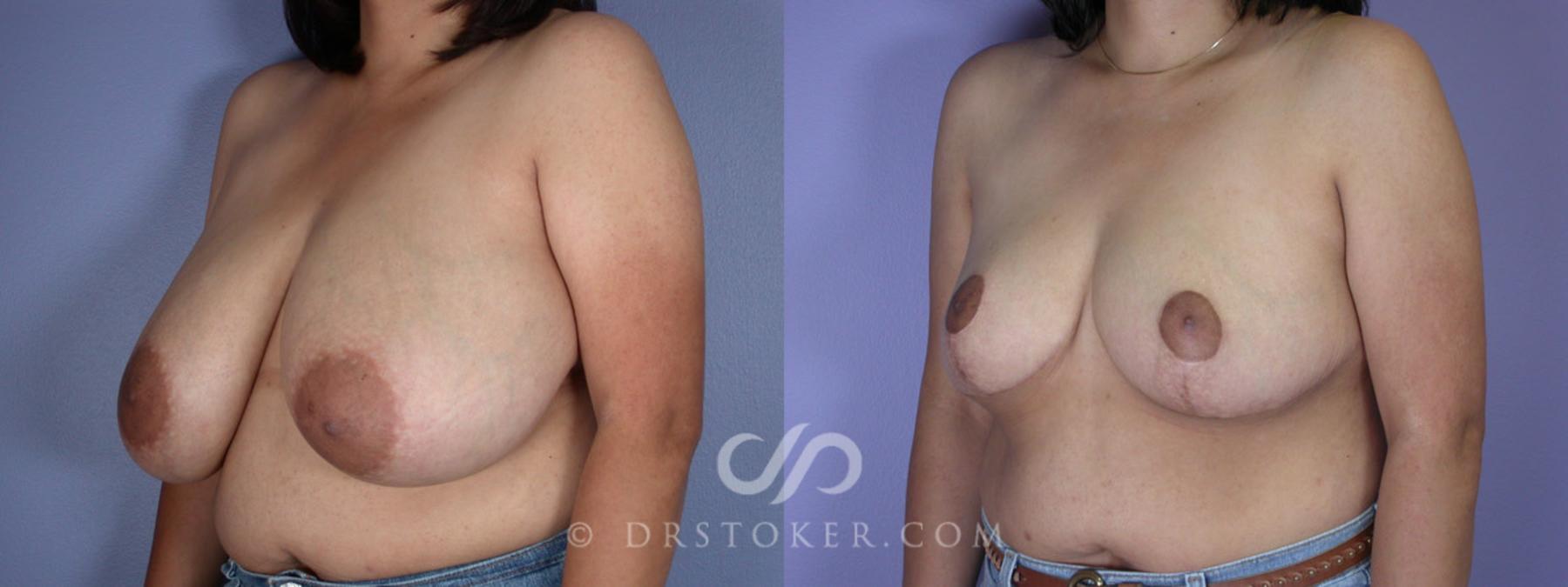 Before & After Breast Reduction (for Women) Case 222 View #3 View in Los Angeles, CA