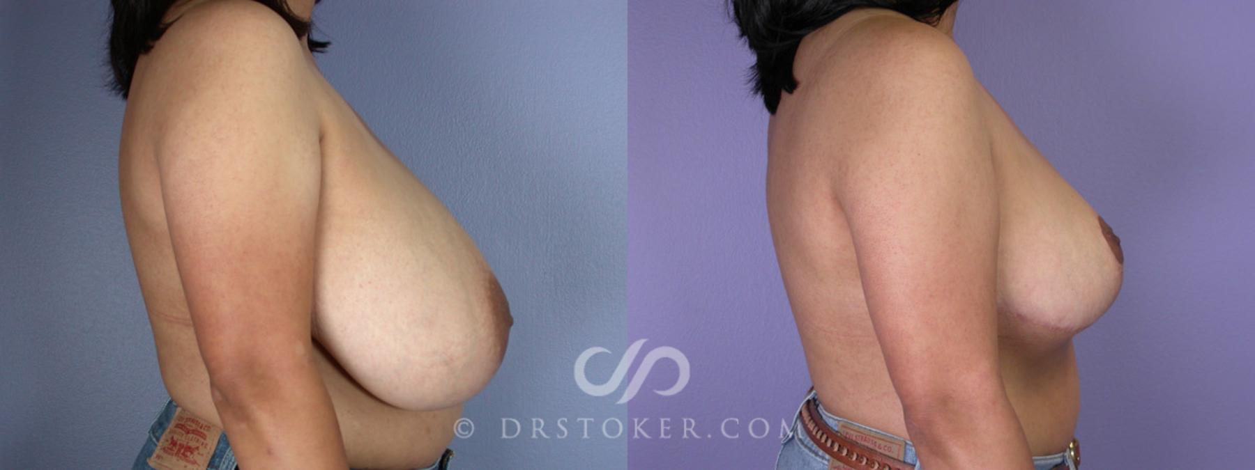 Before & After Breast Reduction (for Women) Case 222 View #4 View in Los Angeles, CA