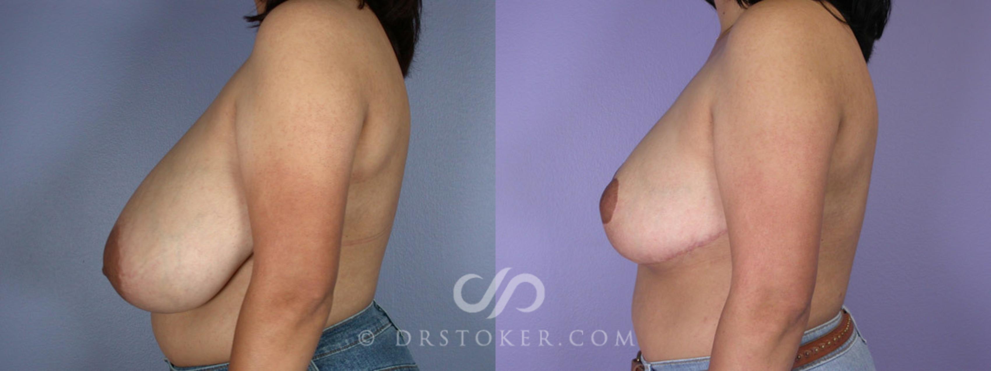 Before & After Breast Reduction (for Women) Case 222 View #5 View in Los Angeles, CA