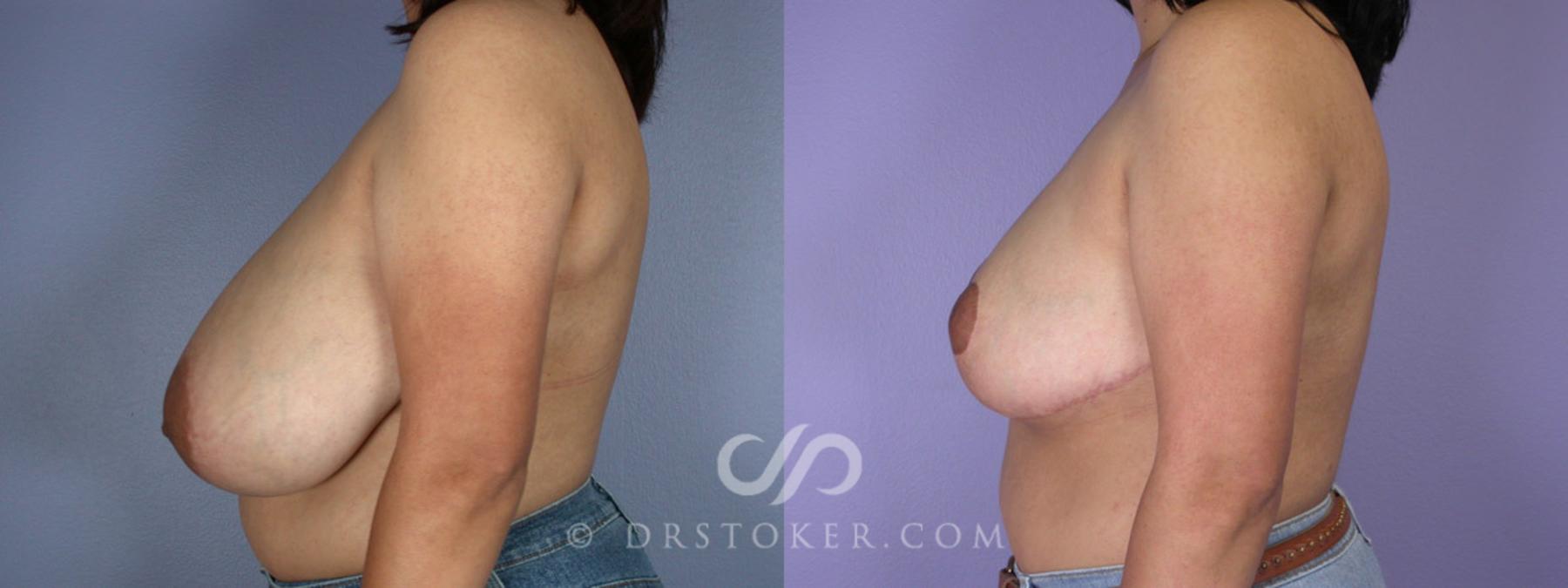 Before & After Breast Reduction (for Women) Case 222 View #5 View in Los Angeles, CA