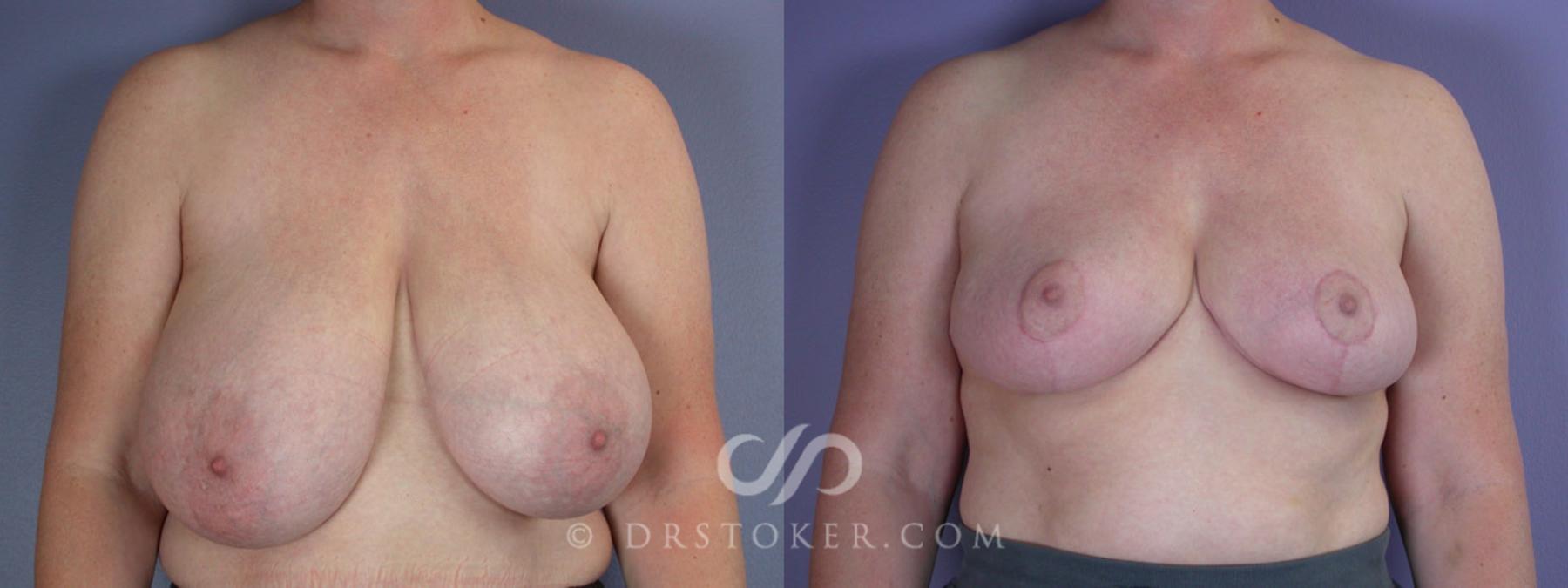 Before & After Breast Reduction (for Women) Case 223 View #1 View in Los Angeles, CA