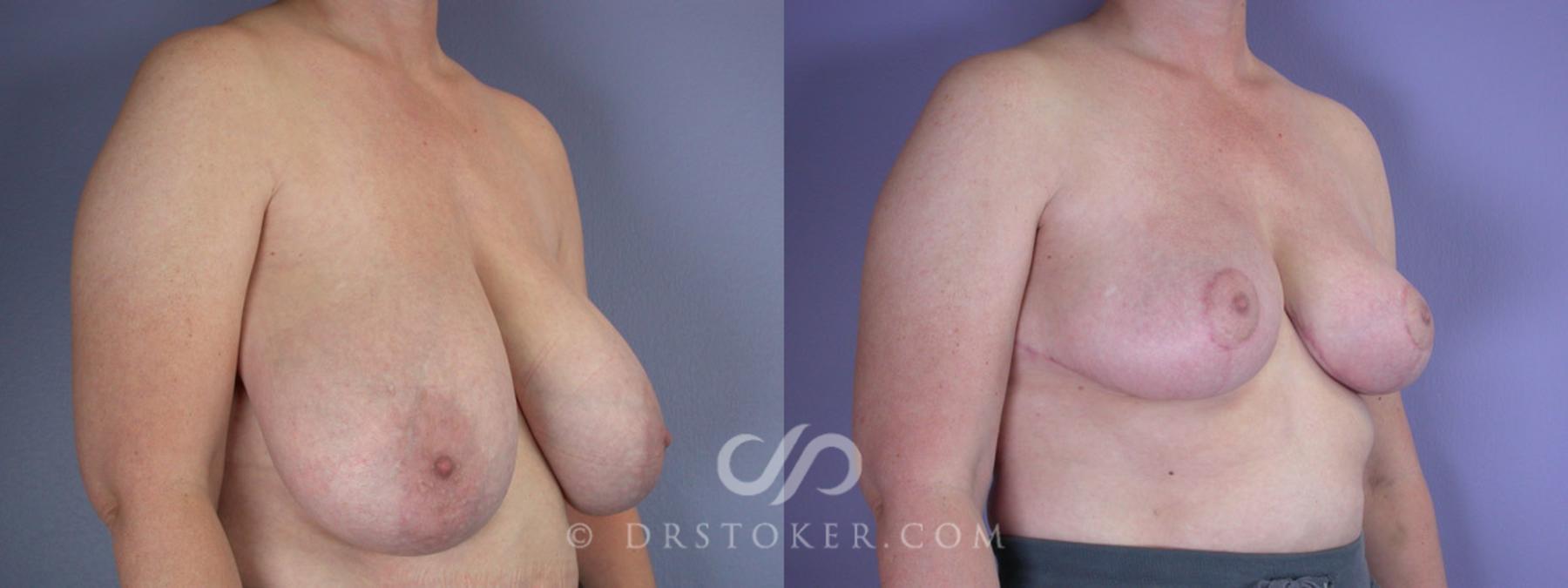 Before & After Breast Reduction (for Women) Case 223 View #2 View in Los Angeles, CA