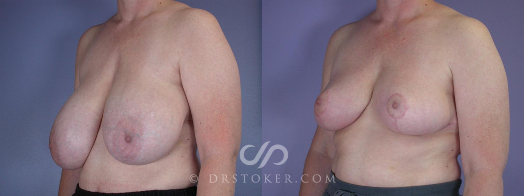 Before & After Breast Reduction (for Women) Case 223 View #3 View in Los Angeles, CA