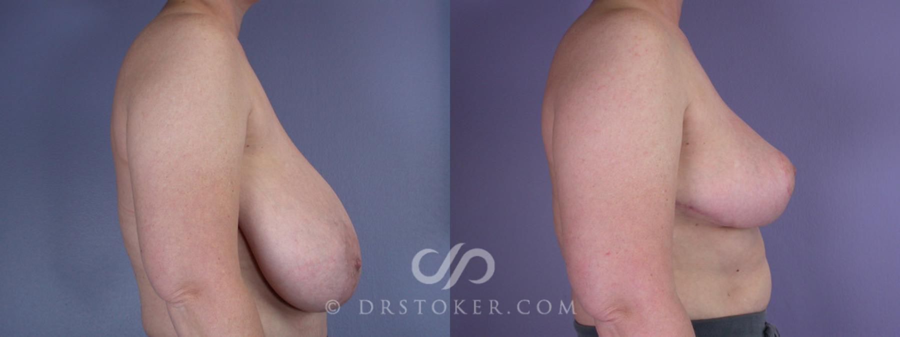 Before & After Breast Reduction (for Women) Case 223 View #4 View in Los Angeles, CA