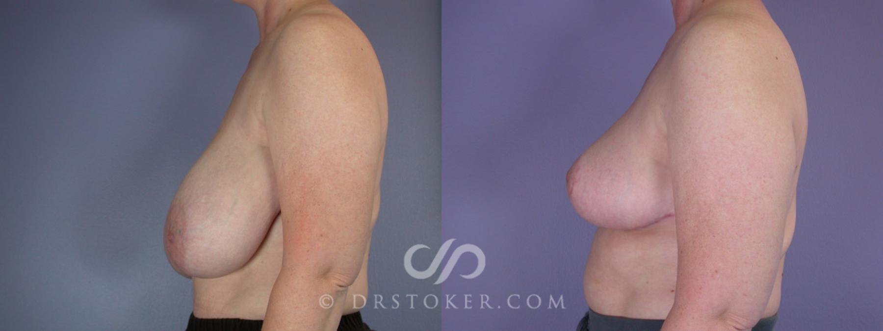 Before & After Breast Reduction (for Women) Case 223 View #5 View in Los Angeles, CA