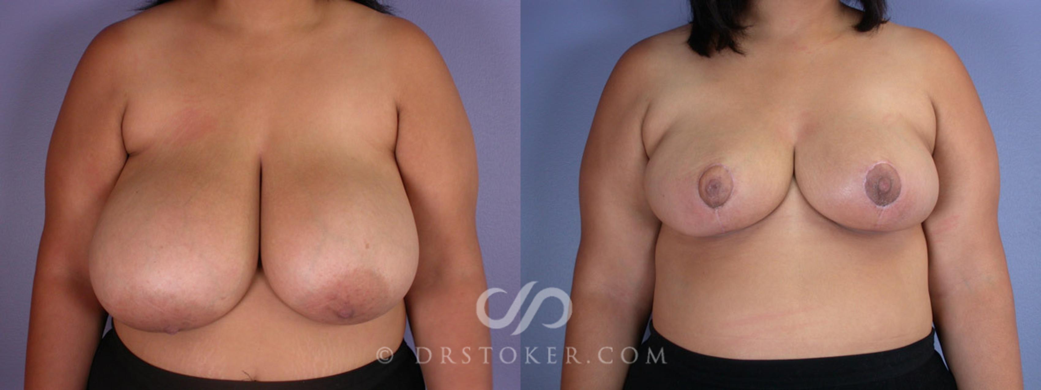 Before & After Breast Reduction (for Women) Case 224 View #1 View in Los Angeles, CA