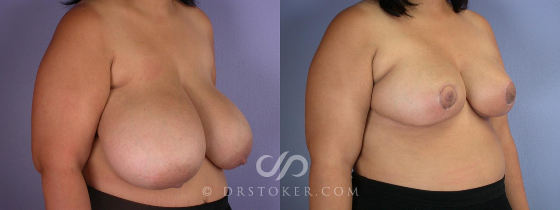 Before & After Breast Reduction (for Women) Case 224 View #2 View in Los Angeles, CA