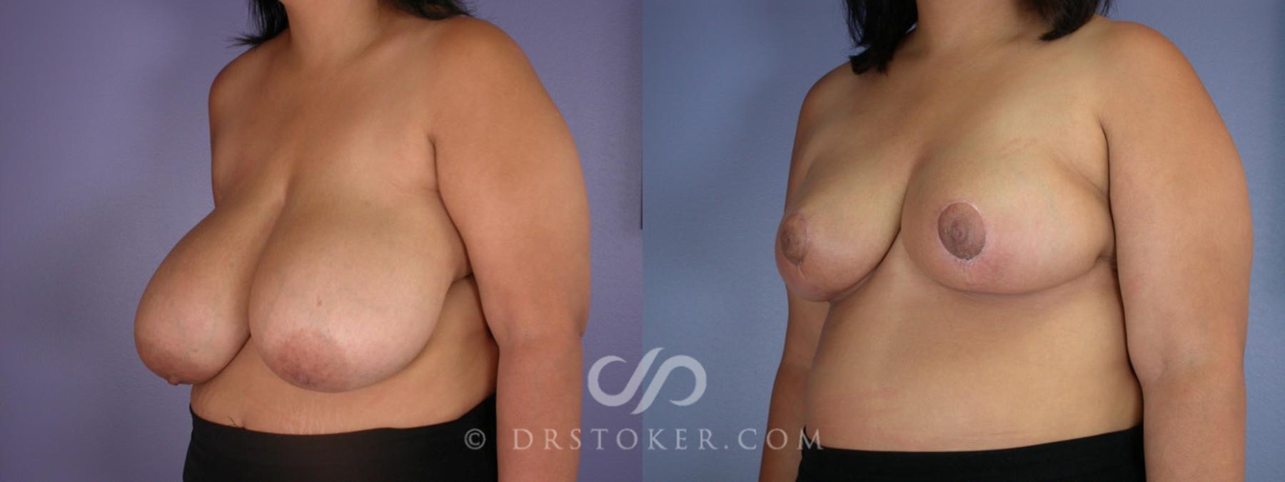 Before & After Breast Reduction (for Women) Case 224 View #3 View in Los Angeles, CA