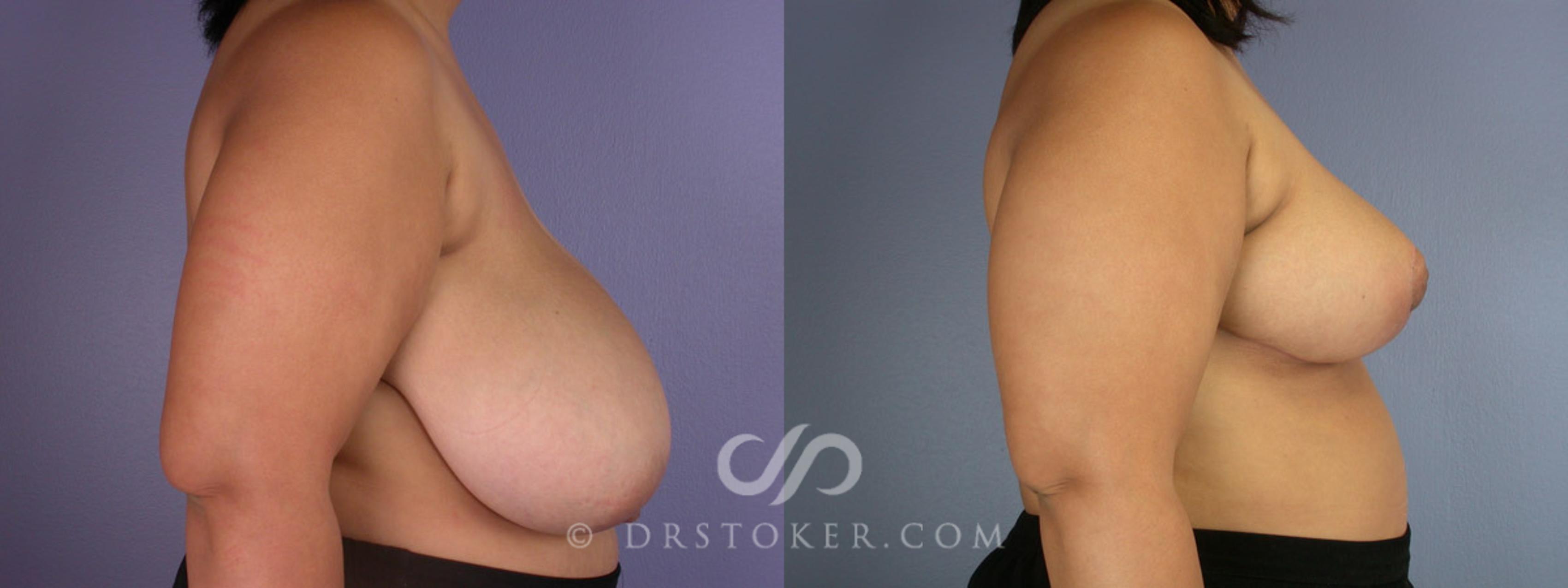 Before & After Breast Reduction (for Women) Case 224 View #4 View in Los Angeles, CA