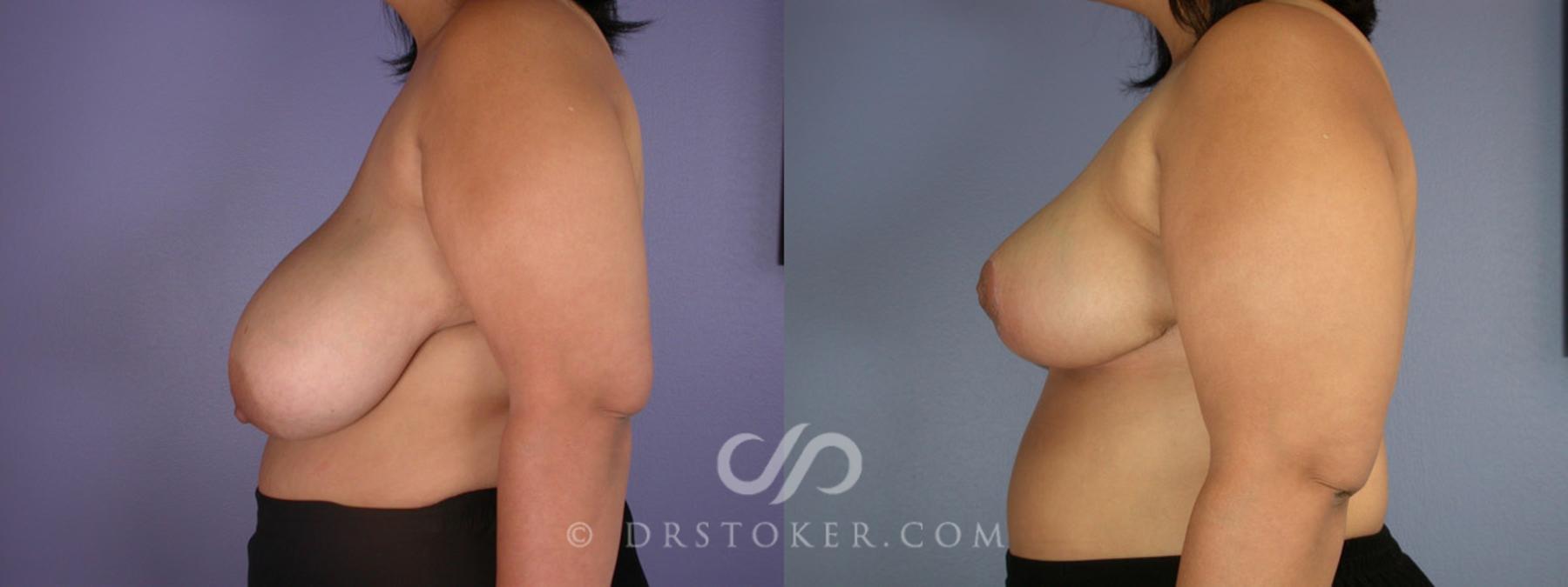 Before & After Breast Reduction (for Women) Case 224 View #5 View in Los Angeles, CA