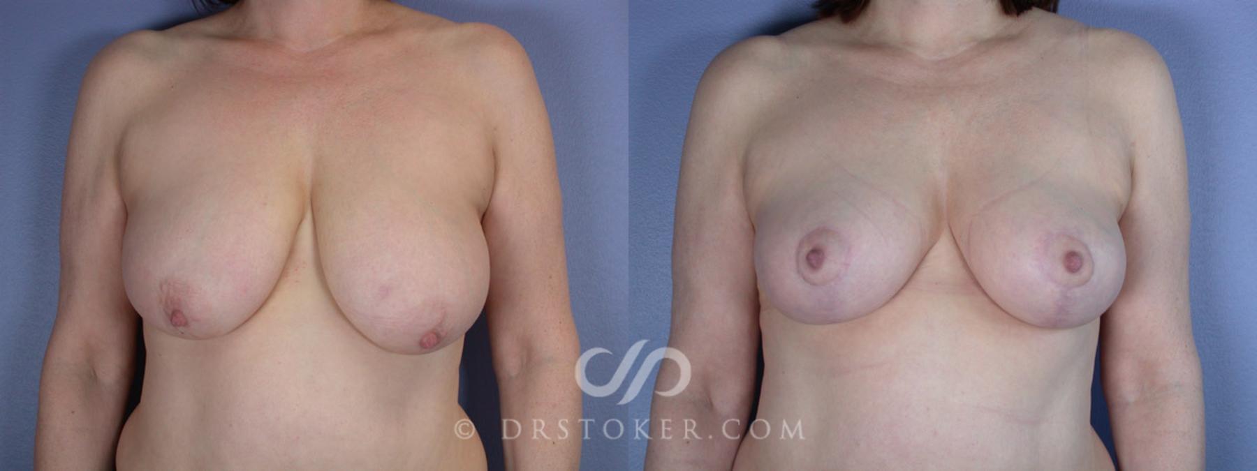 Before & After Breast Reduction (for Women) Case 225 View #1 View in Los Angeles, CA