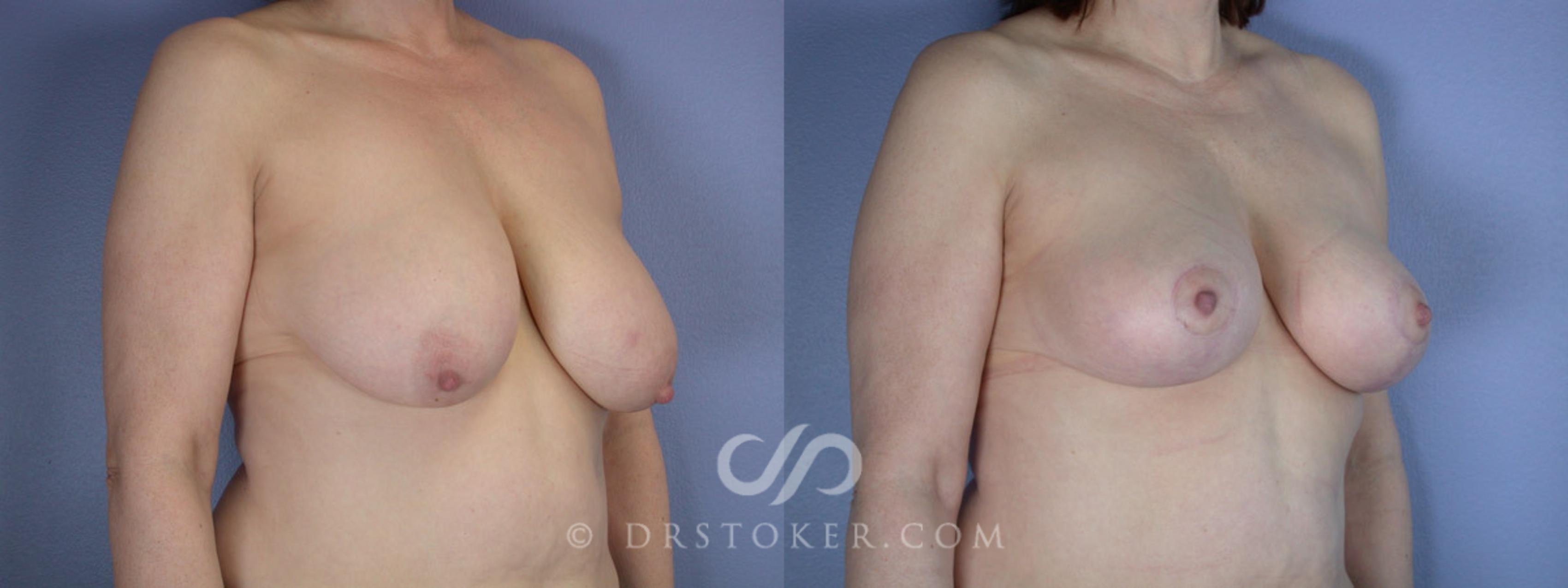 Before & After Breast Reduction (for Women) Case 225 View #2 View in Los Angeles, CA