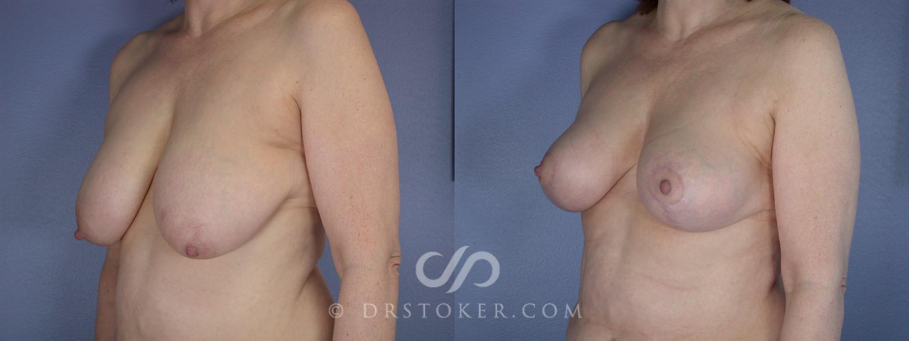 Before & After Breast Reduction (for Women) Case 225 View #3 View in Los Angeles, CA
