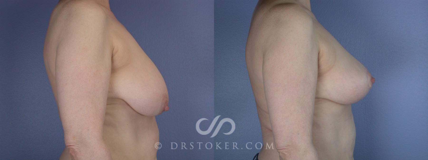 Before & After Breast Reduction (for Women) Case 225 View #4 View in Los Angeles, CA