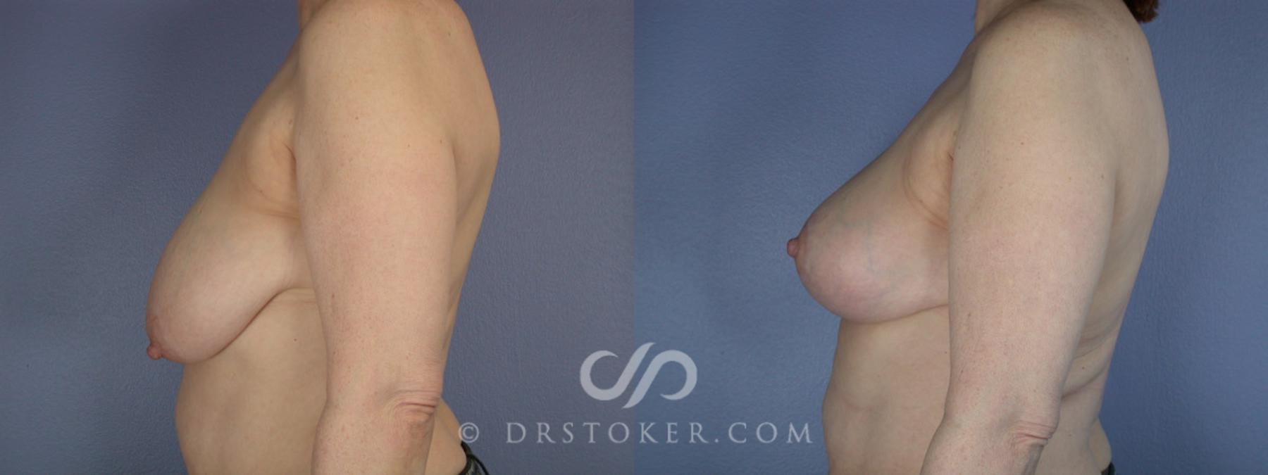 Before & After Breast Reduction (for Women) Case 225 View #5 View in Los Angeles, CA
