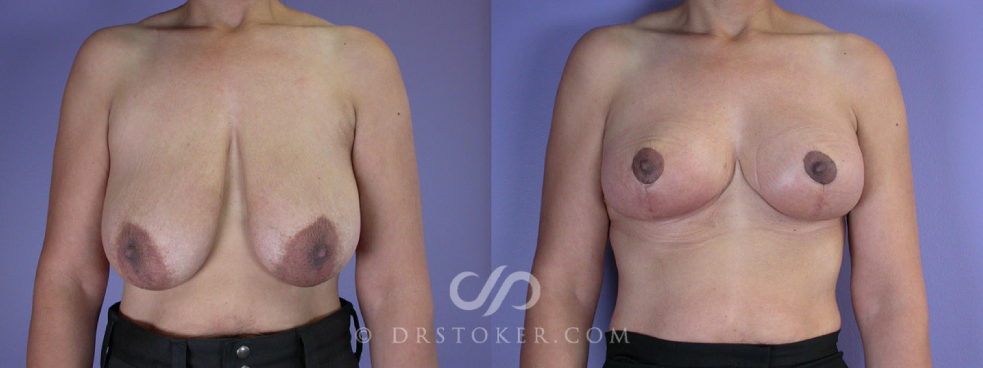 Before & After Breast Reduction (for Women) Case 226 View #1 View in Los Angeles, CA