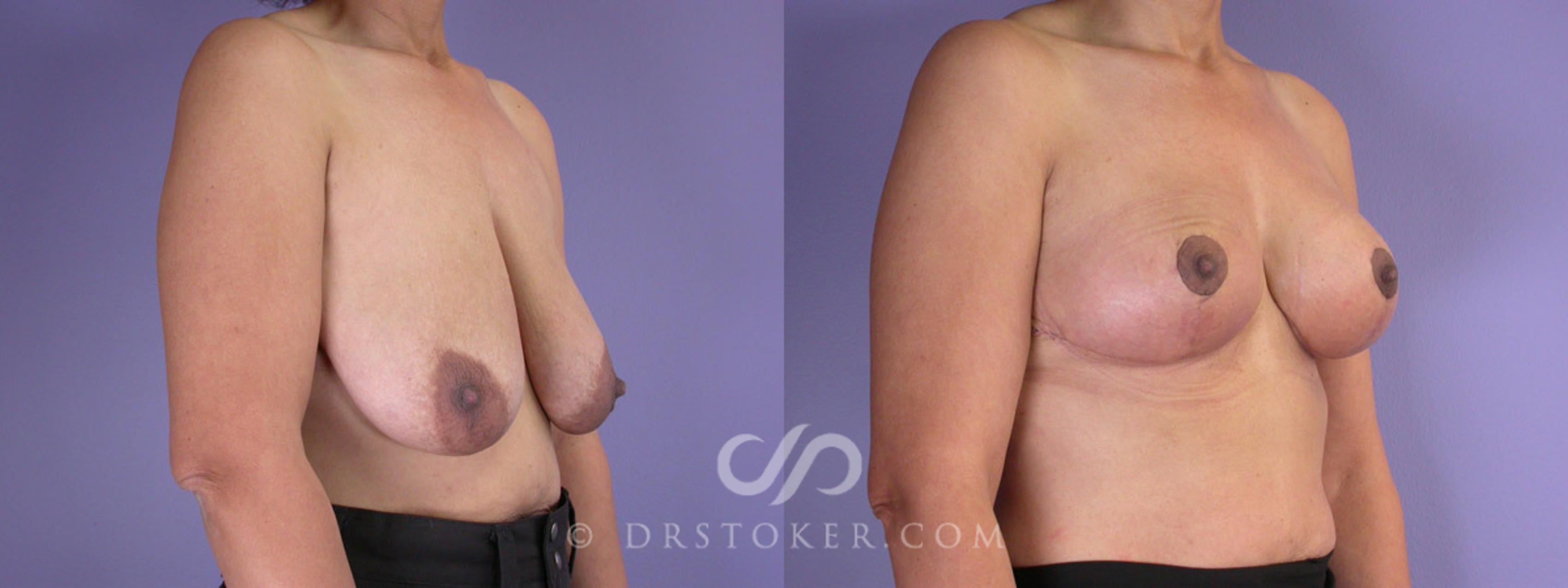 Before & After Breast Reduction (for Women) Case 226 View #2 View in Los Angeles, CA