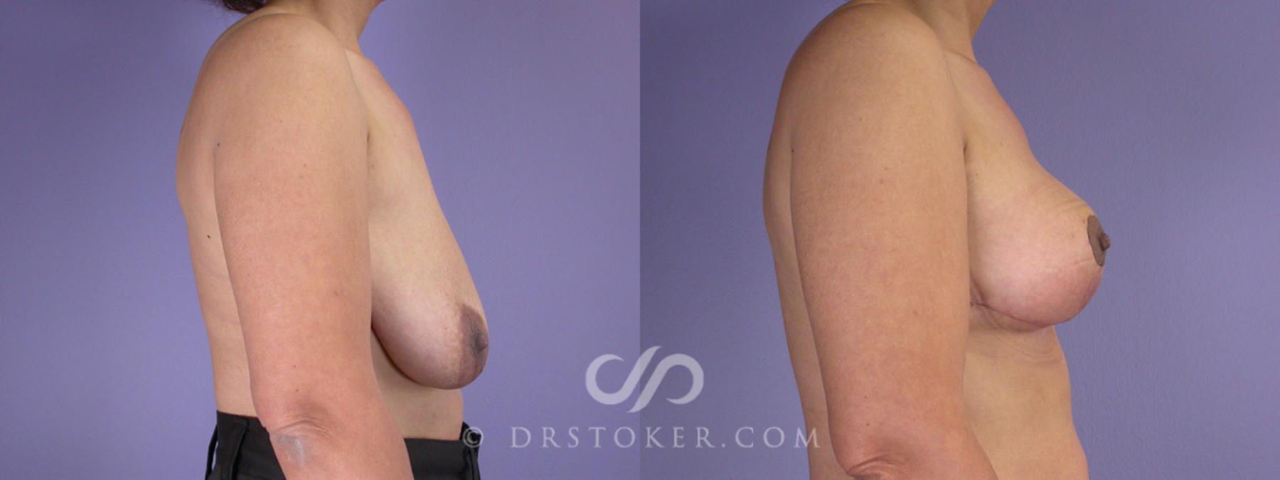 Before & After Breast Reduction (for Women) Case 226 View #3 View in Los Angeles, CA