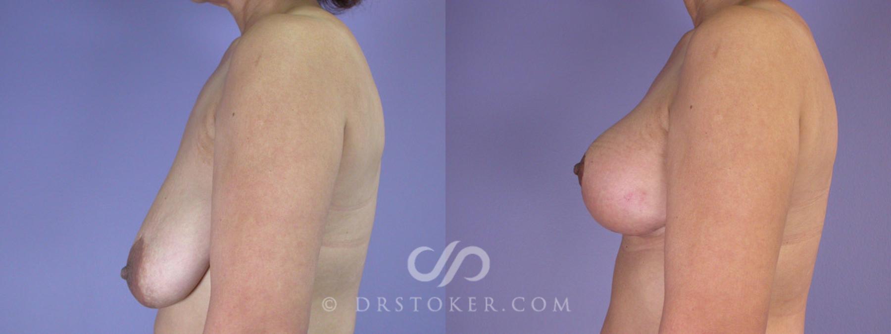Before & After Breast Reduction (for Women) Case 226 View #4 View in Los Angeles, CA